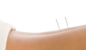 acupuncture